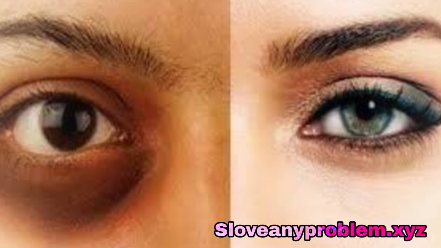 চোখের রোগ কি কি ? What are eye diseases?